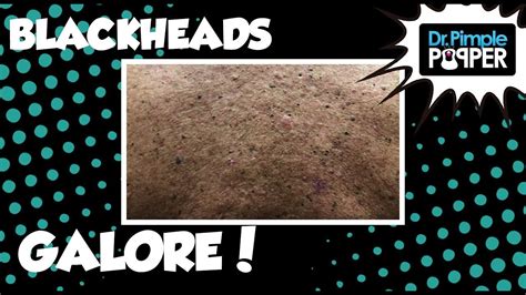 tu e falore|Back Blackheads Galore .